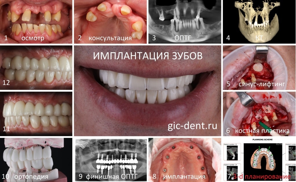 этапы имплантации зубов в Немецком имплантологическом центре